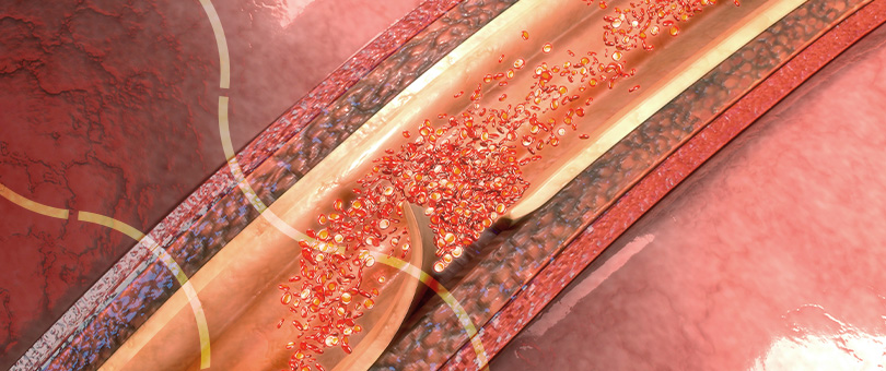 weverton-terci-imagem-interna-aneurisma-e-disseccoes-de-aorta