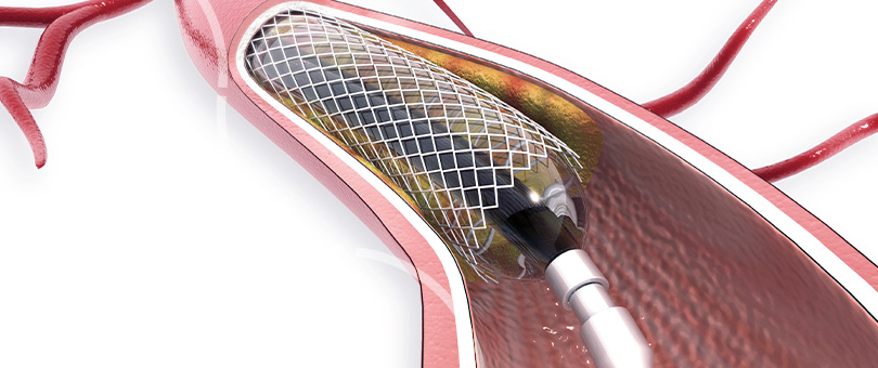 weverton-terci-imagem-interna-colocacao-de-stents-em-obstrucoes-venosas